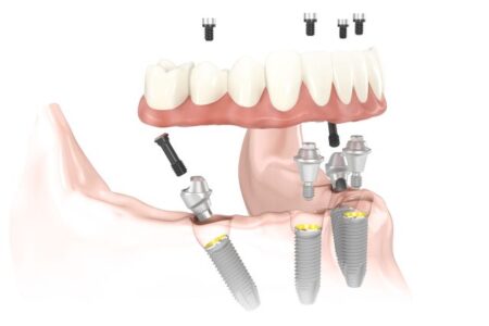 Digital drawing of an implant-supported denture being attached to four dental implants that have been placed according to the All-on-4 technique to avoid bone grafting.