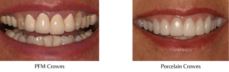 Side-by-side photos compare a woman's smile before and after her PFM crowns were replaced with porcelain crowns. Porcelain crowns are an important part of metal-free dentistry.