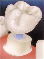 Digital drawing of a crown being fit over a prepared tooth. Angels Smile Dental Care offers same-day crowns.