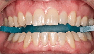 Before photo of a patient treated with Opalescence Pro teeth whitening.