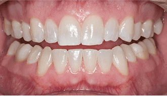 After photo of a patient treated with Opalescence Pro teeth whitening.