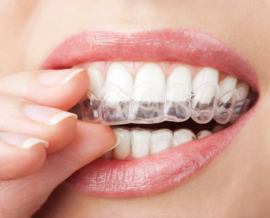A woman places a whitening tray over her teeth.
