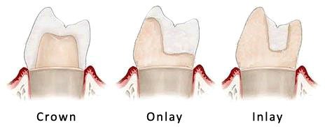 Drawing that illustrates the difference between a crown, an onlay, and an inlay. Onlays and inlays may be recommended when a tooth is too decayed to be restored with white fillings.
